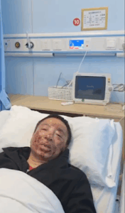 江苏无锡维权人士沈爱斌在派出所遭警察殴打,鼻梁骨折-1984bbs